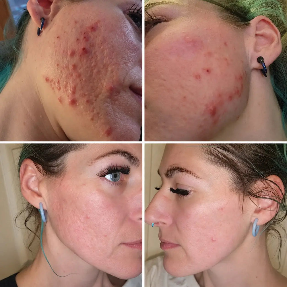 Cheek skin before LED treatment with active breakouts, and after with visibly reduced breakouts and redness