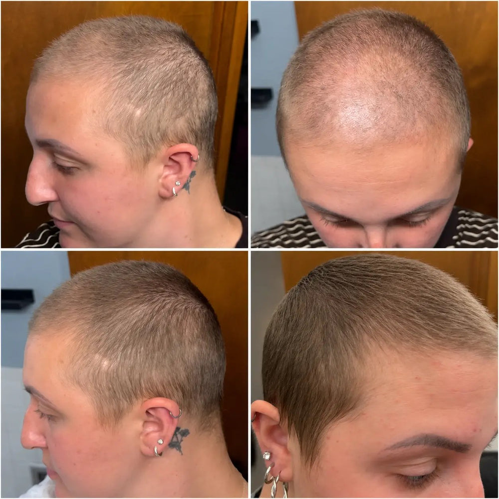 Scalp before LED treatment with visible thinning, and after with denser, fuller hair regrowth