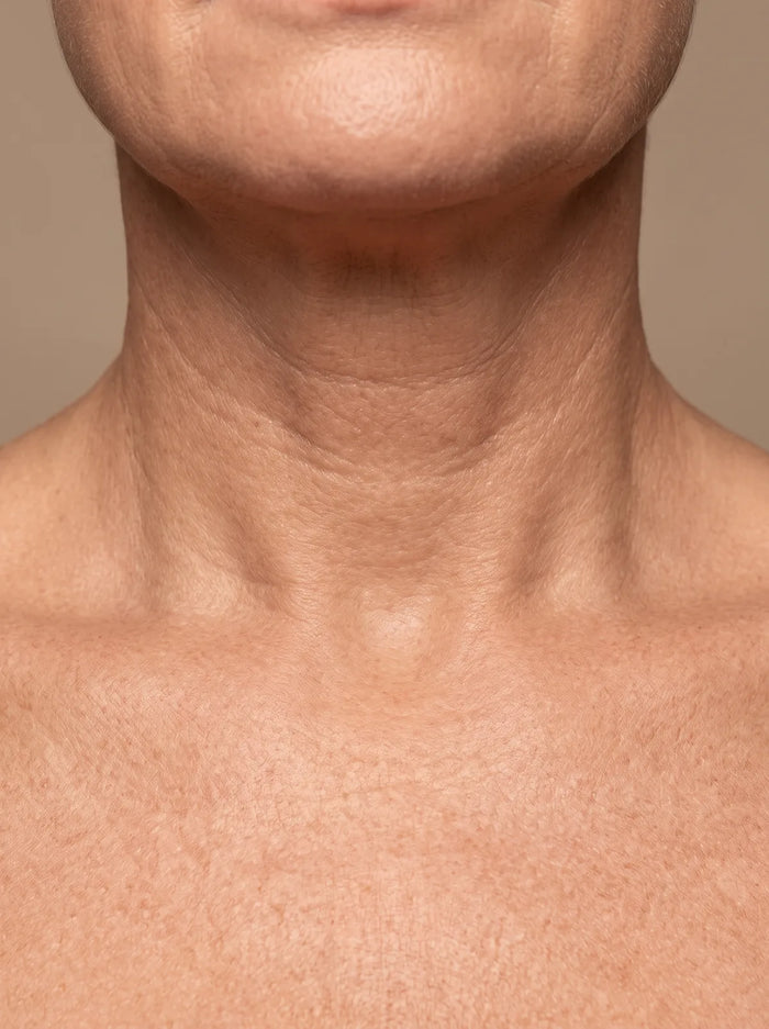 Neck skin before LED treatment with visible fine lines and creases